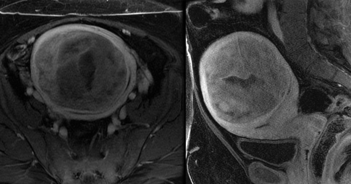 علاج داخل الرحم بدون شق جراحي: إزالة البوليبات، الأورام الليفية، والالتصاقات باستخدام منظار الرحم المكتبي