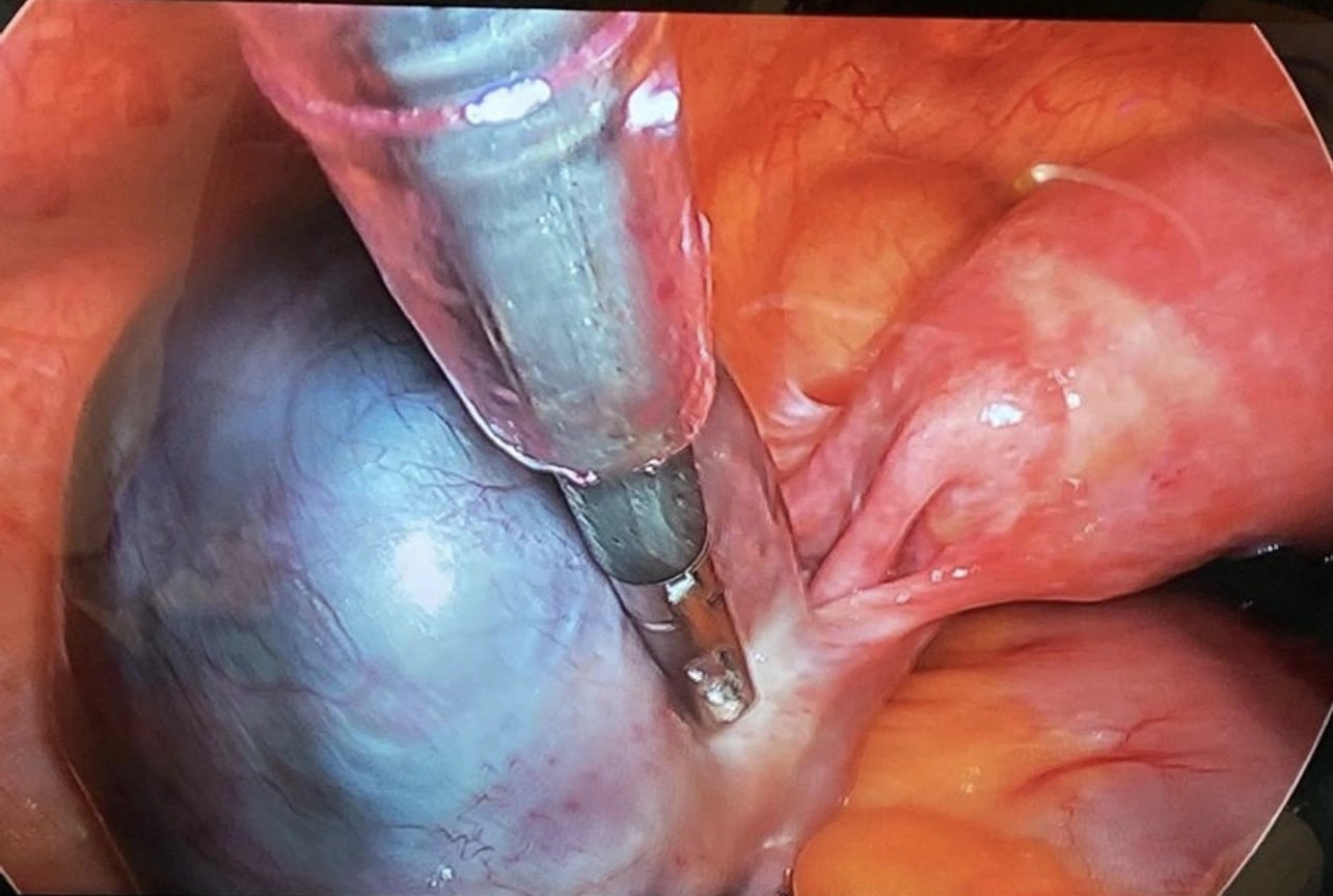 Laparoskopik çikolata kisti ameliyatı sırasında yumurtalıktan endometrioma kistinin çıkarılması - Doç. Dr. Cengiz Andan