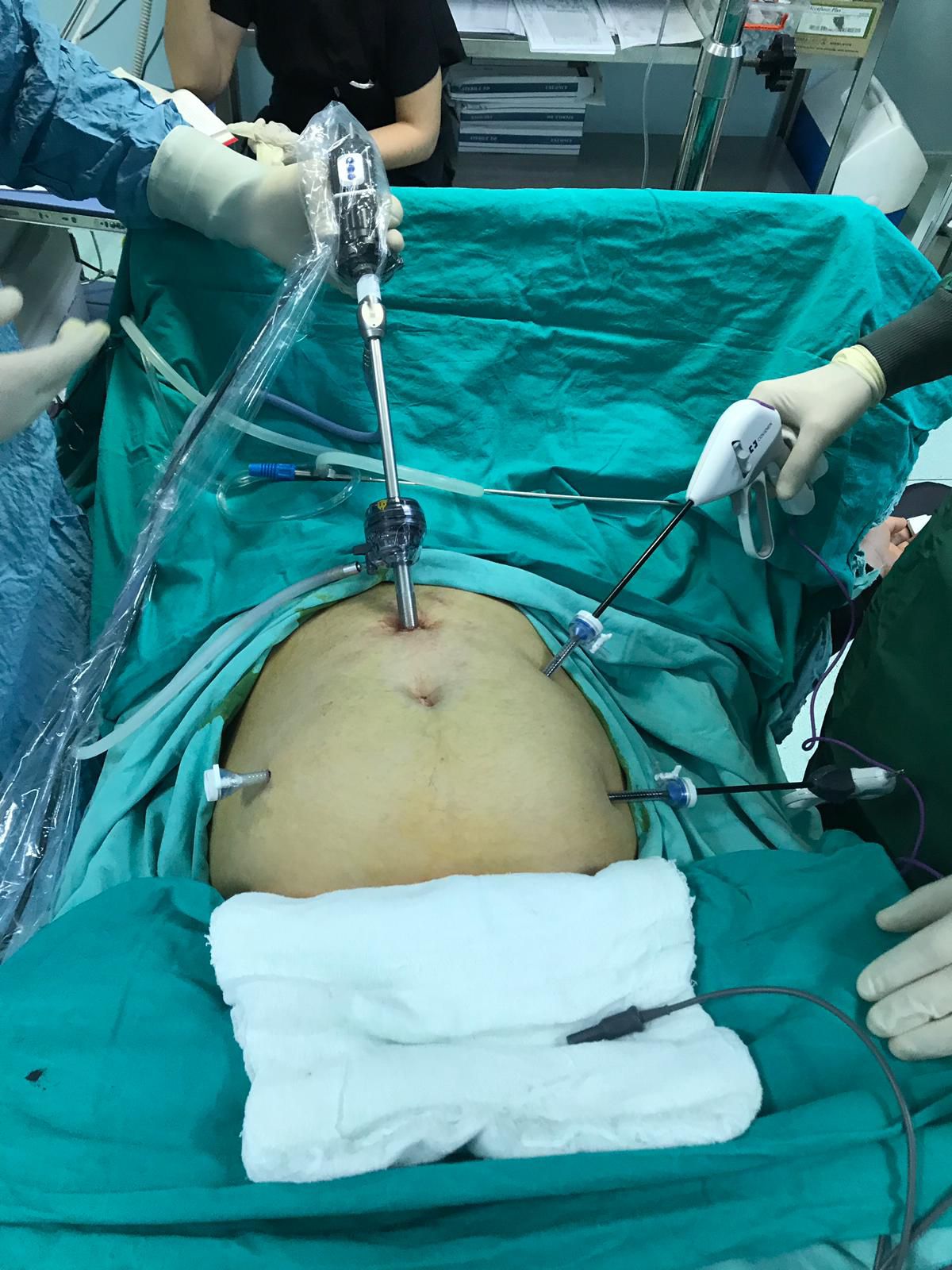 Laparoskopik miyom ameliyatında karından giriş ve trokar yerleşimi - Doç. Dr. Cengiz Andan, İstanbul