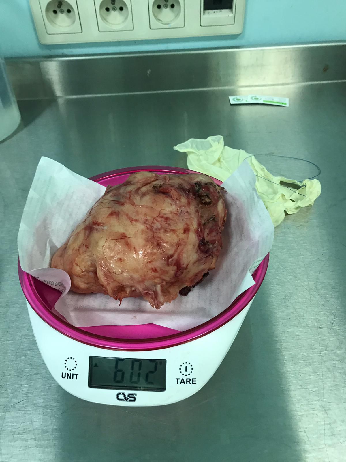 Miyom ameliyatında çıkarılan büyük miyom - 602 gram - Doç. Dr. Cengiz Andan, İstanbul
