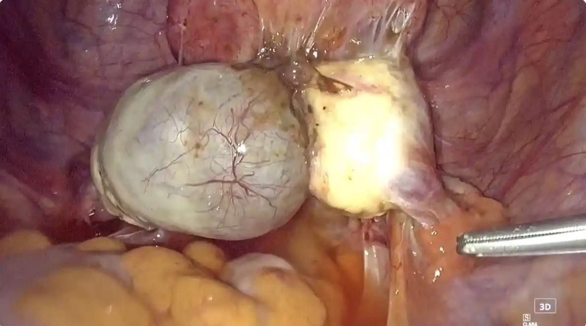 Beurteilung eines ovariellen Endometrioms