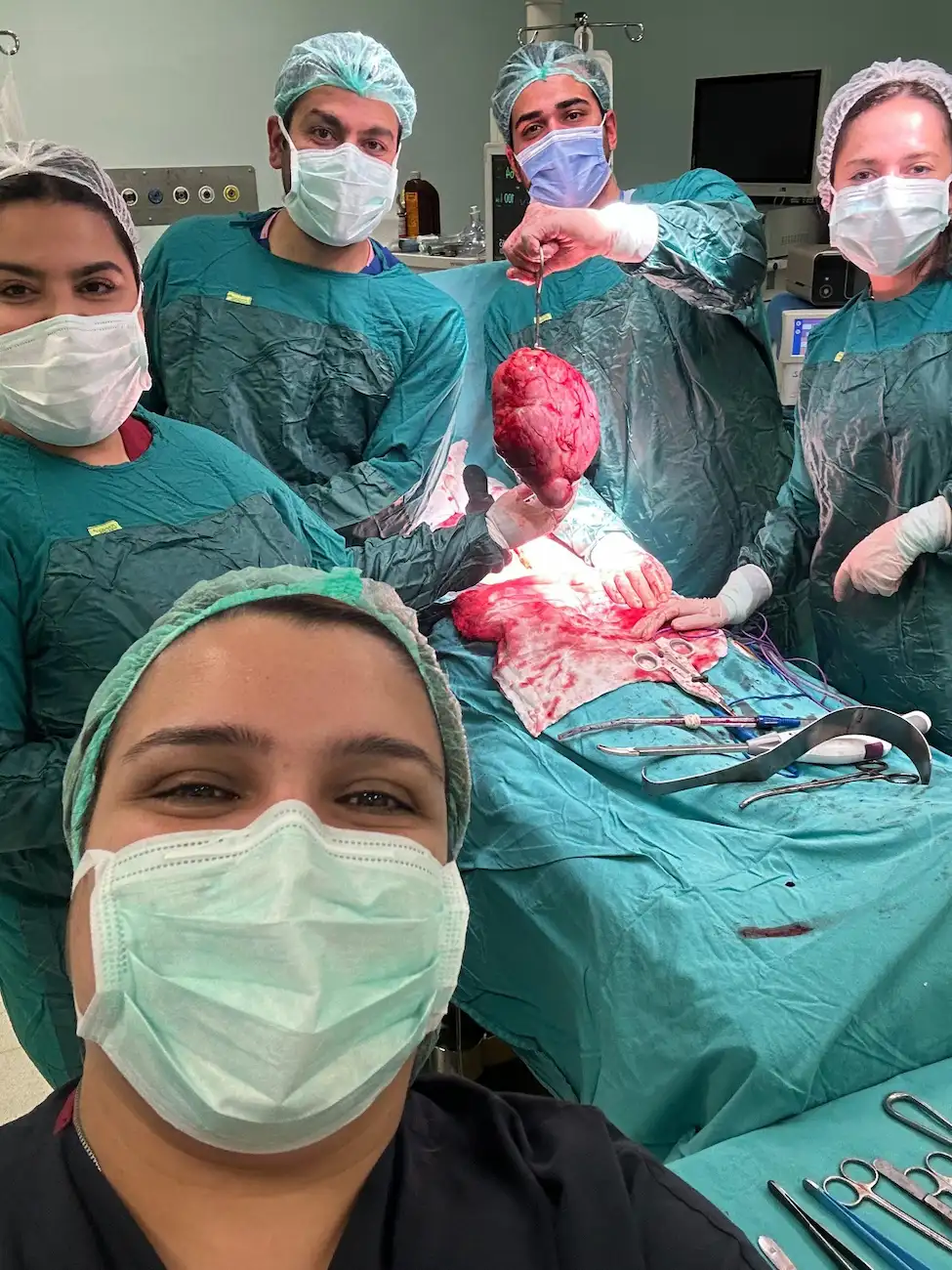 Riesiges Uterusmyom nach gebärmuttererhaltender Operation in Istanbul - Assoc. Prof. Dr. Cengiz Andan
